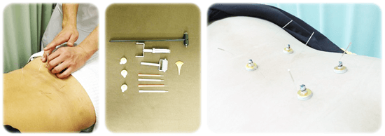 ぎっくり腰　鍼灸